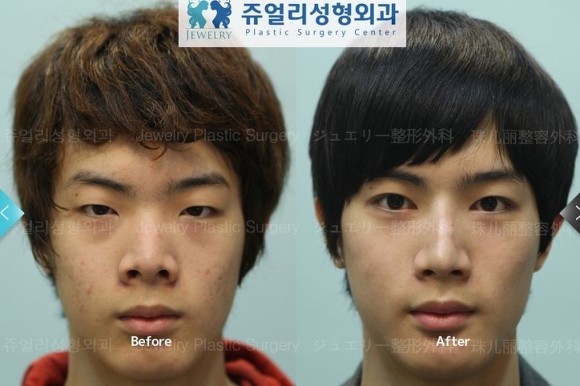 성형수술 성공한 케이스.jpg | 인스티즈